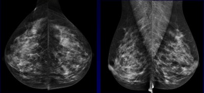 A 62-year-old woman with nonpalpable 9-mm invasive ductal carcinoma only seen on ultrasound (below). A radial sonogram obtained at the 5 o'clock position in the left breast shows a hypoechoic irregular mass. All mages courtesy of Dr. Veronica Girardi.