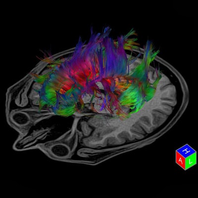 Tractography is a 3D modeling technique used to visually represent neural tracts using data collected by diffusion tensor imaging. Image courtesy of Toshiba.