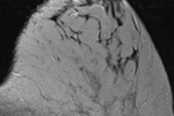 2015 03 04 22 11 01 677 2015 03 05 Breast Thumb