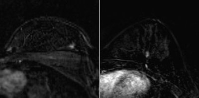 Breast cancer lesions that were missed in screening with MRI but detected by CAD. The arrows indicate the lesions. All images courtesy of Albert Gubern Mérida, PhD.