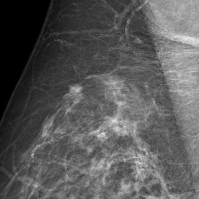 A 68-year-old asymptomatic woman underwent routine mammographic screening (above). A subtle small spiculated mass was correctly detected by CAD in the upper-outer quadrant of the right breast, best seen on the mediolateral oblique (MLO) view (below). Percutaneous biopsy and subsequent surgical excision confirmed a 10-mm well-differentiated, lymph-node-negative invasive ductal cancer in the right breast [pT1b pN0 (sn) G1], which had an excellent prognosis due to its early detection through mammography screening. Images courtesy of Dr. Ulrich Bick.