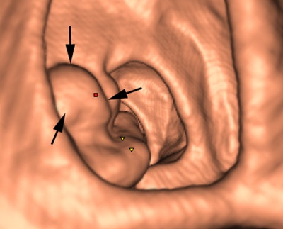 Above: 3D endoluminal image of the ascending colon demonstrates an irregular polypoidal lesion (arrows) correctly identified by CAD. In a reader study, this lesion was initially missed and only detected using second-read CAD by two of 10 readers. Below: Coronal CT colonographic image of the rectum demonstrates a CAD false positive. The CAD (red mark) has incorrectly marked a normal rectal vein (arrows). Images courtesy of Dr. Stuart Taylor.