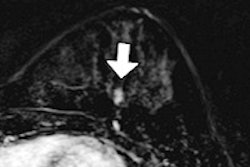 2015 03 06 13 33 52 997 Breast Mri 4b 200