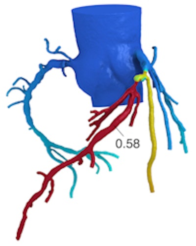The HeartFlow FFR-CT analysis is a noninvasive test that applies computational fluid dynamics to CT data to determine the extent that coronary artery obstructions are impacting blood flow to the heart. Here, a color-coded image from the HeartFlow analysis shows an artery with a 0.58 FFRCT value, indicating a lesion that may be functionally significant. Image courtesy of HeartFlow.