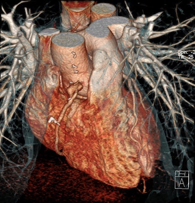 The availability of 3D volume-rendered techniques has enhanced the clinical value of coronary CT angiography examinations. Images courtesy of Dr. Hatem Alkadhi.