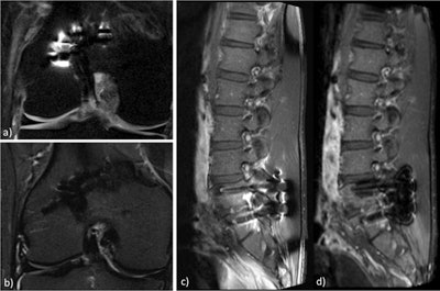 Fat suppression may be quite challenging whenever metallic materials are present. The fat-sat technique (a) may be replaced by short tau inversion recovery (STIR) (b) when the evaluation of the cartilage is not the main focus of the exam. In cases of postoperative spine scanning (c), the three-point Dixon technique (d) allows for more homogeneous fat suppression than with fat saturation, which improves the analysis of the surrounding soft tissues when looking for evidence of infection or fibrosis. Images courtesy of Sofia Brandão.