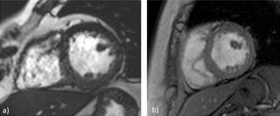 In cardiac imaging, steady-state free precession (SSFP) images (a) are quite useful for a dynamic evaluation of myocardial function. These sequences are prone to radiofrequency and magnetic field heterogeneities, and, therefore, they are sometimes replaced by spoiled gradient-recalled echo (GRE) images (b), despite the slight contrast decrease between the myocardium and the heart chambers. Images courtesy of Sofia Brandão.