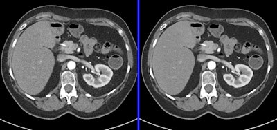 Abdominal study