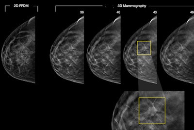 A 46-year-old woman's routine screening mammogram: 2D mammogram is essentially negative. Digital breast tomosynthesis (3D mammography) images reveal a 15-mm spiculated mass between slices 38-48, diagnosed as invasive ductal carcinoma, grade 2. Figure courtesy of Dr. Per Skaane, PhD.
