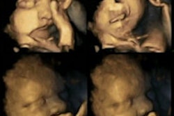 2015 03 23 16 32 32 379 Fetal Ultrasound Smoking 200