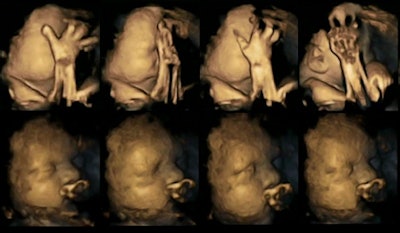 4D ultrasound scans show movement differences in two fetuses at 32 weeks, above and below. The top strip of each image shows movements of a fetus whose mother smoked, while the bottom strip shows a fetus whose mother did not smoke. Images courtesy of Dr. Nadja Reissland, Durham University.