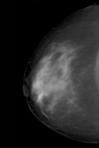 Craniocaudal view of 52-year-old woman with a BRCA 1 gene mutation