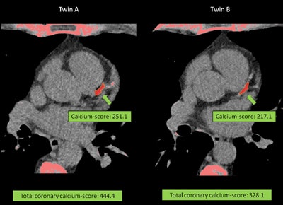 Coronary artery calcium (CAC) scoring of the same monozygotic twin pair depicted in Figure 1. The proximal LAD plaque CAC score is indicated in green text box for twin A and twin B.