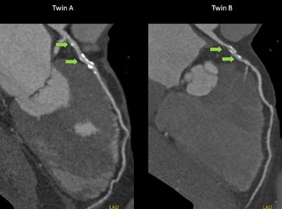 Coronary CTA of a monozygotic twin pair. The curved multiplanar reconstructions show proximal calcified and partially calcified atherosclerotic plaques (green arrows) of twin A and twin B. All images courtesy of Dr. Pál Maurovich-Horvat.