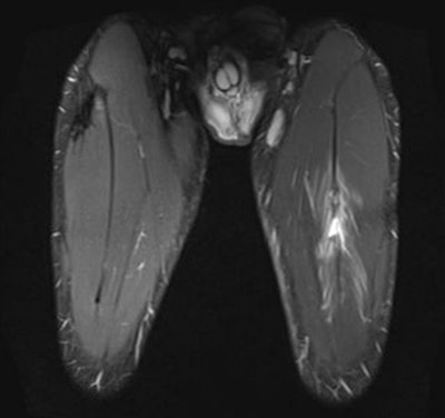 A 24-year-old male professional football player who presented with sudden onset of pain following striking of the ball. Above: Coronal STIR MRI demonstrates focal defect within the left rectus femoris central muscle at the musculotendinous junction. Note the feathery edema pattern within the muscle radiating from the primary injury site. Below: Extended field-of-view ultrasound demonstrates loculated hematoma at the musculotendinous junction with surrounding increased reflectivity within the rectus femoris muscle. All images courtesy of Dr. Justin Lee, Chelsea and Westminster Hospital.