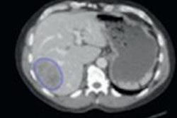 2015 04 06 11 44 55 375 2015 04 07 Colorectal Cancer Pic1 20150406184644