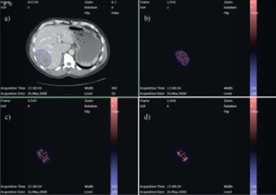 Evaluation of a colorectal liver metastasis with TexRAD CT texture analysis. Definition of a region of interest (a), and textures at different filtration levels corresponding to fine, medium, and coarse (b, c, d). All images courtesy of Dr. Anselm Schulz.