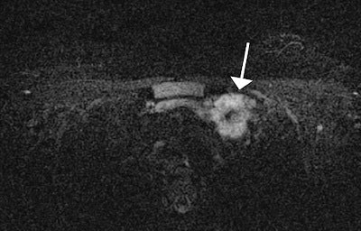 Axial TIRM MR image of 23-year-old woman with breast cancer