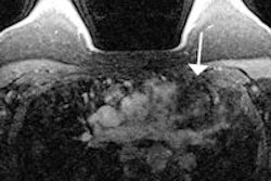 2015 04 09 15 35 47 337 2015 04 10 Extramammary Thumb