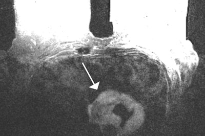 Axial TIRM MR image of 70-year-old woman with a history of breast cancer and incidental gastrointestinal stromal tumors