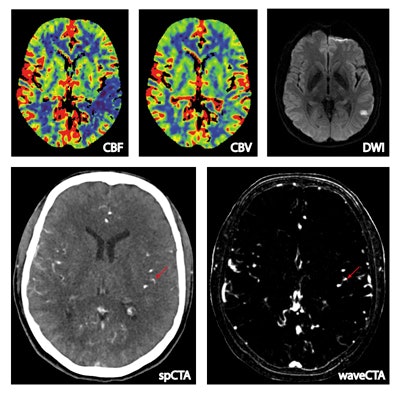 Above, a 55-year-old man presenting with right-sided hemiparesis and aphasia. Whole-brain CT perfusion (WB-CTP) shows a left-sided perfusion deficit in the middle cerebral artery territory with a mismatch between CBF und CBV. Follow-up MRI shows a relatively small final infarction volume. The wavelet-based CTA reconstructed from WB-CTP data demonstrates an M3 occlusion that is not evident in conventional CTA.