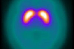 2015 04 16 10 55 35 255 2015 04 17 Medphysweb Spect Jne Fig2a 20150416180436