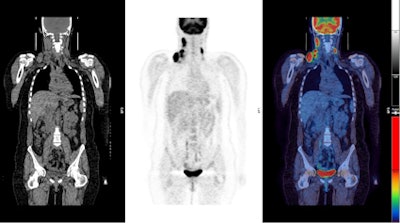 PET/CT images show a Hodgkin's lymphoma patient with inadequate response to treatment or 'positive' PET scan after chemotherapy treatment. There was high uptake in lymph nodes on both sides of the neck prior to treatment (above) with persistent high uptake in the right neck after treatment; Deauville score 5 (below). The Deauville criteria is a five-point scoring system used to calculate uptake in PET images. A score of 5 would indicate the greatest amount of uptake. Physiological uptake is seen in the bladder.
