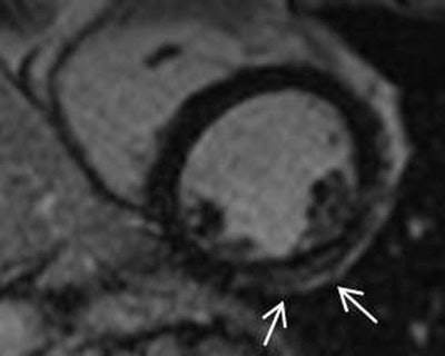 Above and below: Short-axis MR images from a 1.5-tesla scanner showing late gadolinium enhancement in two different female Duchenne muscular dystrophy carriers (38-year-old carrier above, 34-year-old carrier below). All images courtesy of Dr. Juliane Schelhorn.