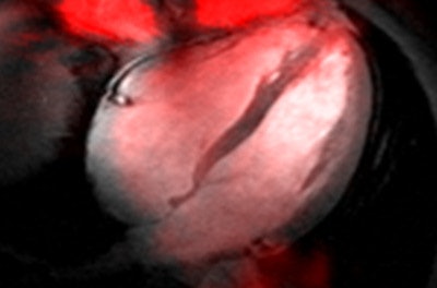 Above: Sodium (Na-23) MR image (red) of a four-chamber view of the human heart superimposed to a 2D CINE image (gray). The Na-23 image of the heart was acquired at 7 tesla using a density-adapted short echo-time 3D radial technique. Below: Fluorine (F-19) MR image (red) of an axial view through the human knee superimposed to an anatomical image (gray). The F-19 image was acquired at 7 tesla following topical application of an ointment containing flufenamic acid -- an F-19-containing nonsteroidal anti-inflammatory drug (NSAID). A spatial resolution of (1.5 x 1.5 x 5.0) mm3 was accomplished.