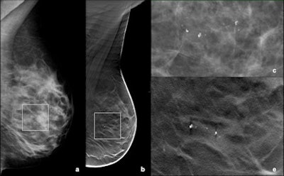 A small group of amorphous microcalcifications was detected in the retro-areolar region of the left breast with both FFDM (a: MLO view; c: particular digitally magnified) and DBT (b: MLO view; d: particular digitally magnified). Vacuum-assisted biopsy was performed and histology showed fibrocystic changes.