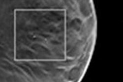 2015 04 30 09 21 35 104 2015 04 30 Dbt Calcifications Pic2 20150430163633