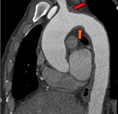 Above, an adult with indeterminate vasculitis that was unreported on echocardiography and seen on CT as mural aortic thickening (orange arrow) with extension into arch vessels (red arrow). Below, an adult with a left atrial appendage tip thrombus that was missed on CT and subsequently detected on echocardiography. The abnormality was noted on CT in retrospect (red arrow).