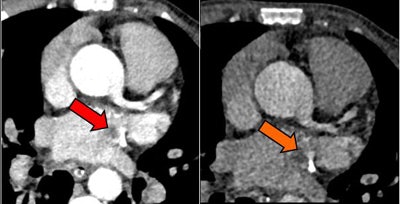 Above, an adult with a left atrial thrombus that was unreported on echocardiography and seen on CT as a filling defect on the arterial (red arrow) and delayed (orange arrow) enhancement phases. Below, an adult with remote inferior myocardial infarction that was unreported on echocardiography and seen on CT as left ventricular inferior myocardial thinning (red arrow). All images courtesy of Dr. Amr Ajlan.