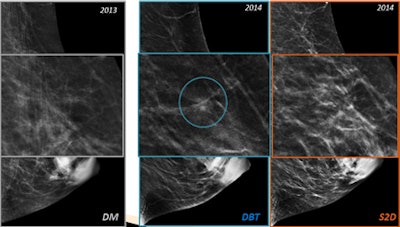 A 48-year-old woman. Synthetic 2D was able to exclude a potential tiny distortion. Left: Digital mammography. Center: DBT. Right: Synthetic 2D.