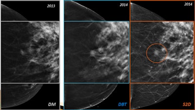 A 60-year-old woman with 7-mm invasive ductal carcinoma in the left breast. Left: Digital mammography. Center: DBT. Right: Synthetic 2D. All images courtesy of Dr. Valentina Iotti.