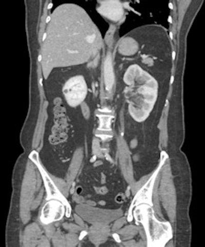 Figure 4: Coronal CT shows a left ureteric calculus.