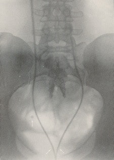 Figure 1: Right-sided opacity is shown separately from the ureter, proving it is a phlebolith.