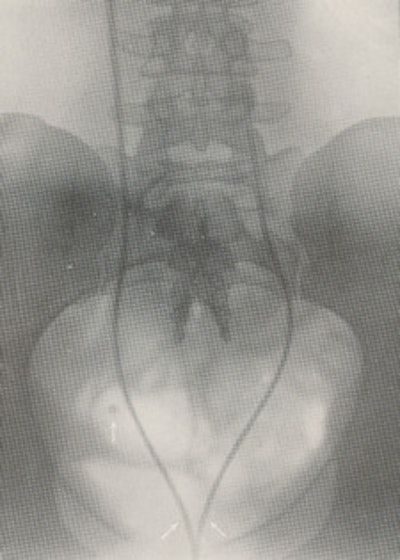 Figure 1: Right-sided opacity is shown separately from the ureter, proving it is a phlebolith.