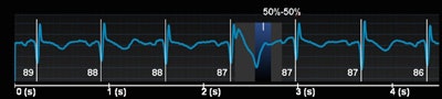 Above: ECG trace showing one-beat cardiac examination; heart rate 87 bpm. Below: Angiographic view. Bottom: Curved and short-axis views demonstrating severe stenosis on left anterior descending (LAD) artery. All images courtesy of GE Healthcare.