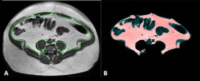 Above: MRI section of a 39-year-old patient, measured at the second and third lumbar vertebrae. The visceral fat is enclosed by the green line in A, and shaded pink in B. Sections of the large intestine are visible in the abdomen. Clinical images courtesy of Klinik für Diagnostische und Interventionelle Radiologie, Universitätsklinikum Leipzig. Below: MRI sections at the second and third lumbar vertebrae in two obese patients. Patient A had much more visceral fat (inside the green line) than patient B, but both had an almost identical body mass index of around 45 kg/m2.