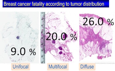 The fatality rate is 2.2 times higher in multifocal cases compared with unifocal breast cancer cases, and 2.9 times higher in women with diffuse breast cancer. Image courtesy of Dr. László Tabár.