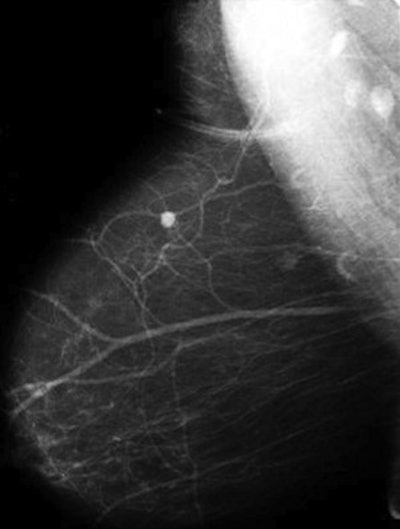 Two examples of nonpalpable, screen-detected unifocal breast cancer smaller than 10 mm. Images courtesy of Dr. László Tabár.