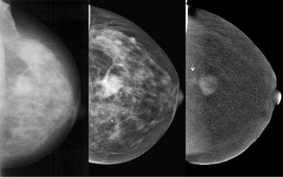 Contrast-enhanced spectral mammography shows a small satellite lesion (arrow) lying dorsally in relation to the primary finding, as well as a third lesion in the mediolateral oblique view projected on to the pectoralis major. This was in a high, deep position and did not appear on the craniocaudal view due to the settings. Image courtesy of Charité Berlin and DRG.