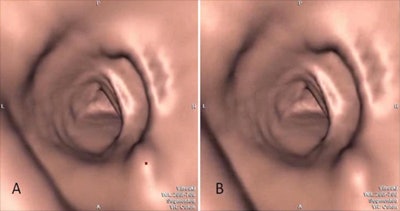 CT colonography images with polyp identified with CAD mark (left) and without (right). Images courtesy of Dr. Steve Halligan.