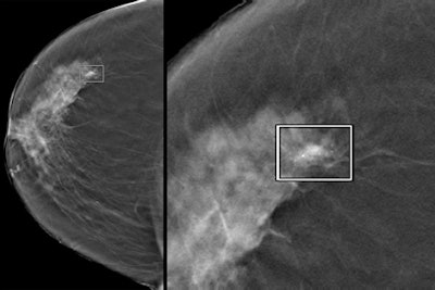 Left: A CAD-detected 12-mm invasive ductal carcinoma with associated microcalcifications. Right: A close-up of the tumor. Images courtesy of Dr. Giovanna Mariscotti from L'Azienda ospedaliero-universitaria San Giovanni Battista in Turin, Italy.