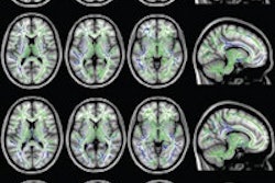 2015 05 26 16 11 15 72 Dti Mri Alzhiemers Radiology 200