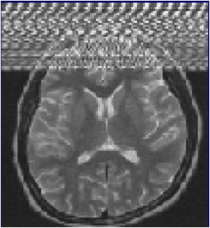 Zipper artifacts, when a radiofrequency (RF) wave interferes with the MRI unit, may occur if a medical device that is not RF-shielded is placed inside the magnet room. Other causes are blinking light bulbs, the examination room door not being tightly closed, and drilling work nearby. Image courtesy of IGK Kusumasuganda, mriforyou.blogspot.co.uk.