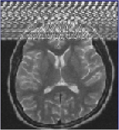Zipper artifacts, when a radiofrequency (RF) wave interferes with the MRI unit, may occur if a medical device that is not RF-shielded is placed inside the magnet room. Other causes are blinking light bulbs, the examination room door not being tightly closed, and drilling work nearby. Image courtesy of IGK Kusumasuganda, mriforyou.blogspot.co.uk.