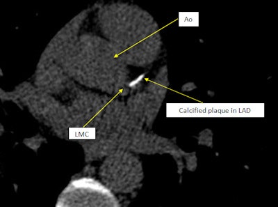 Images of calcified arteries like these can inspire people to change. LMC = left main coronary artery. Ao = aorta. LAD = left anterior descending coronary artery. Image courtesy of Rikke Elmose Mols.