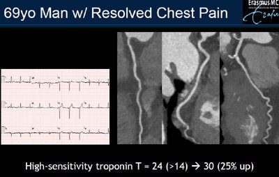In a 69-year-old man with resolved chest pain, initial high-sensitivity troponins results reached 24 ng/L, a little over the 14 ng/L threshold. A second set of markers acquired several hours later came in at 30 ng/L, a 25% increase, prompting a referral to coronary CT angiography, which showed no stenosis. Based on CT, the patient was safely sent home without additional tests. Images courtesy of Dr. Koen Nieman, PhD.